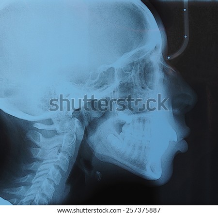 Medical X ray imaging of human skull, teeth and spine of a child