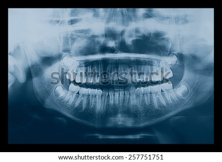 Medical X ray imaging of human teeth of a child