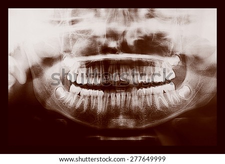Vintage looking Medical X ray imaging of human teeth of a child