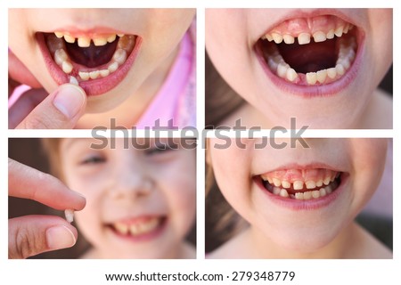 A collage of the child has lost the baby tooth. At 6 years old child loose tooth. The girl is holding the tooth in his hand. New molar tooth growing.