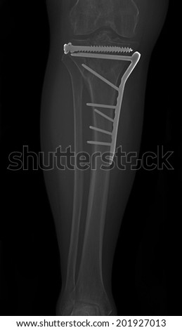 leg bone x-ray