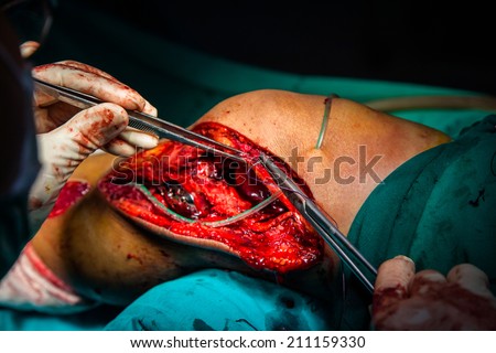 Detail of Surgery, Orthopedic Operation, Knee Surgery