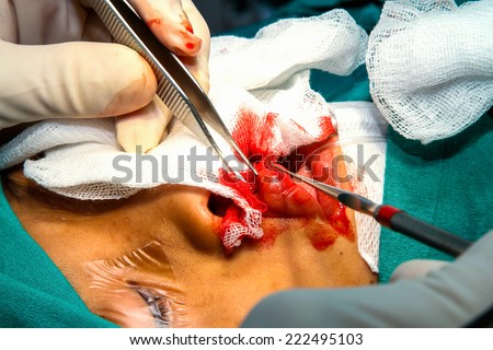 Cleft lip and palate surgery.