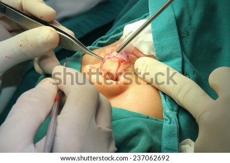 Cleft lip and palate surgery.