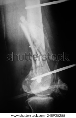 X-ray of the broken leg / Many others X-ray images in my portfolio.