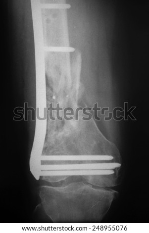 X-ray of the broken leg / Many others X-ray images in my portfolio.