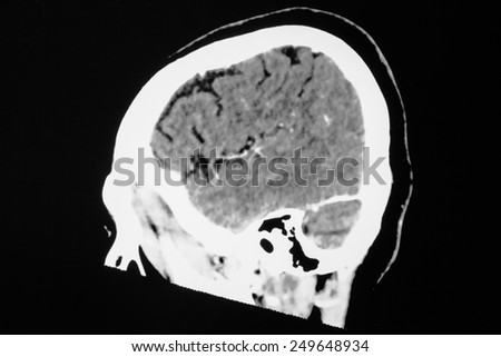 Hemorrhagic Stroke . CT scan (computed tomography) of brain ( cerebrovascular system )