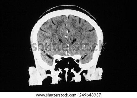 Hemorrhagic Stroke . CT scan (computed tomography) of brain ( cerebrovascular system )