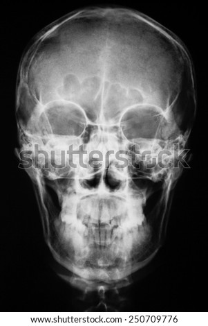 X-ray of head