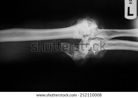 Fracture shaft of ulnar bone ( forearm bone )