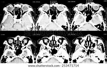 CT scan (computed tomography)