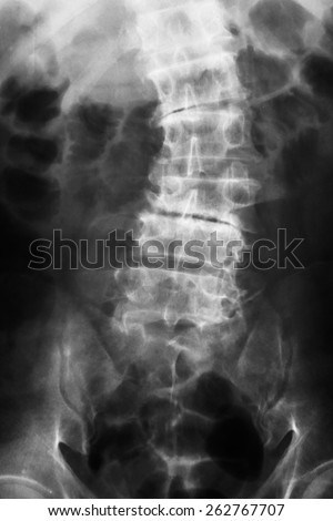 X-ray lumbo-sacral spine and pelvis of asian adult people