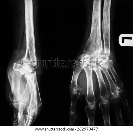human foot ankle and leg xray picture