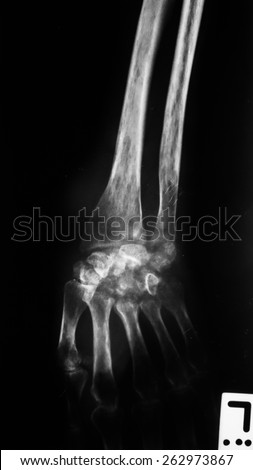 Hand xray image medical background