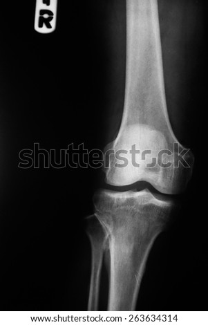 X-rays of leg fracture patients