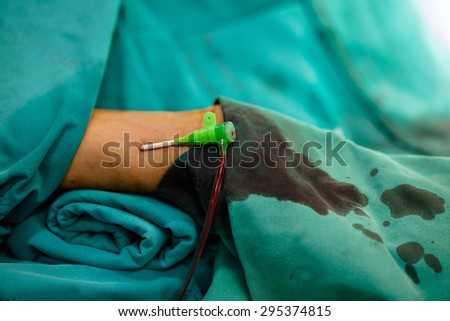 Cardiologist  Inserting Tube Into Patient in cardio catheterization room