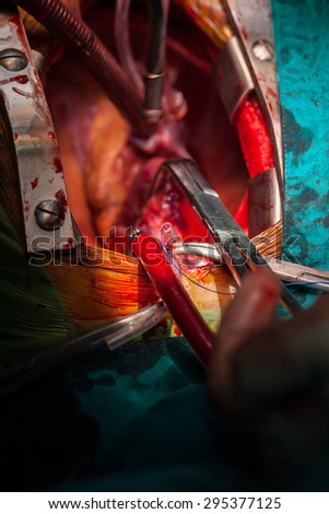 Heart surgery in operating room