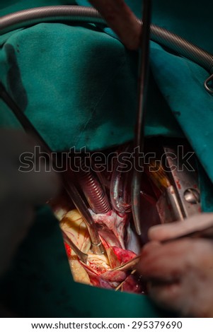 Heart  surgery  in operating room