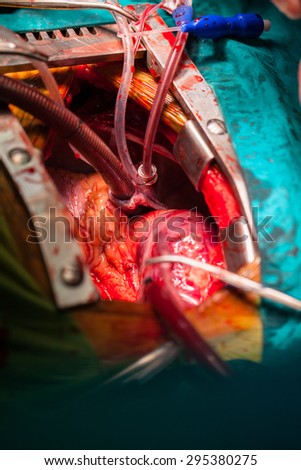 Heart  surgery in operating room
