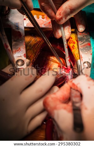 Heart  surgery in operating room