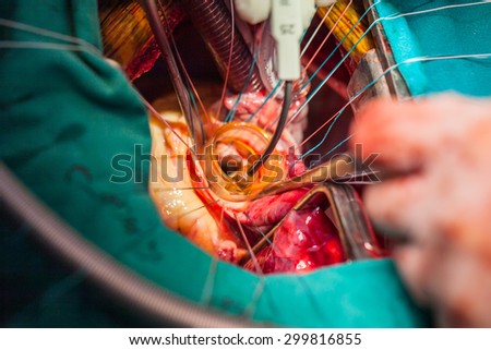 Heart surgery in operating room