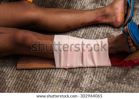 Patient with broken leg