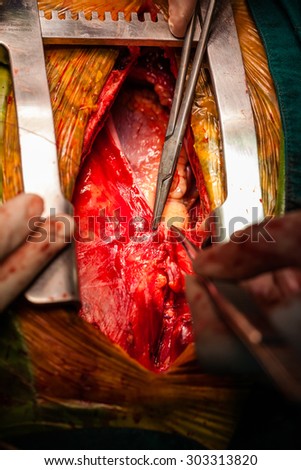 Open heart surgery.