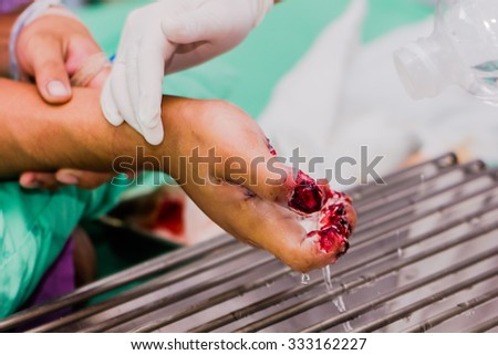 Serious hand  wound  in  Emergency room