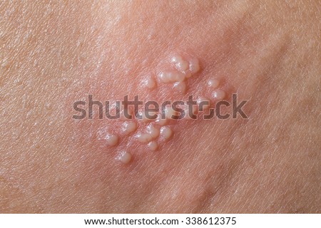 Herpes on the human body