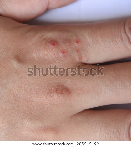 Inflammation of the skin on hands dry skin rash and itching