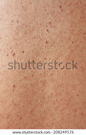 Girl with problematic skin and acne scars in the back