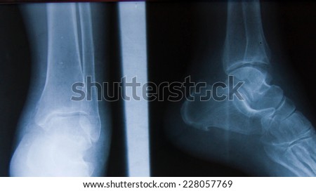 X-ray of the ankle in two profiles, signs of fracture in the fibula
