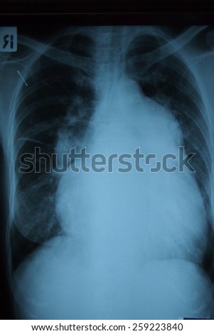 film chest x-ray image of a heart disorder.