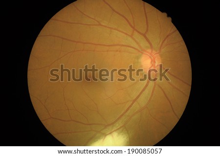 Disorders of sclera  Retinal picture ,Medical photo tractional (eye screen) retinal  detachment of diabetes