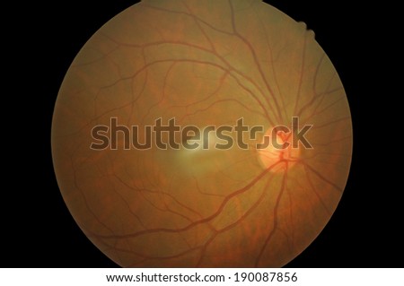 Retinal picture ,Medical photo tractional (eye screen) retinal  detachment of diabetes
