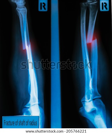 X-Ray Image  fracture shaft of radius & ulnar bone  for a medical diagnosis