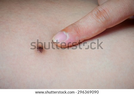 Birthmark on skin, Close-up of Finger pointing on black marks from insect bites over  woman leg.