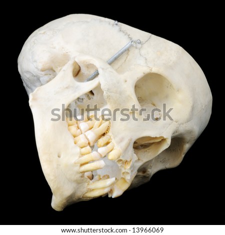 Real human skull with hinged jaw and some missing teeth.  Sideways view with skullcap removed.