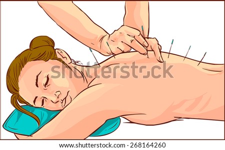 A vector illustration of a woman receiving acupuncture treatment