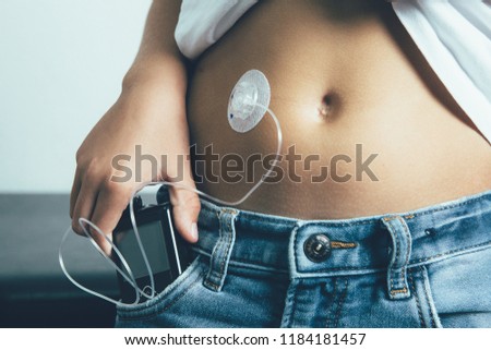 Close up view of the abdomen of a diabetic child with an insulin pump dressing connected in his abdomen and keeping the insulin pump in his pocket. Child diabetes concept.