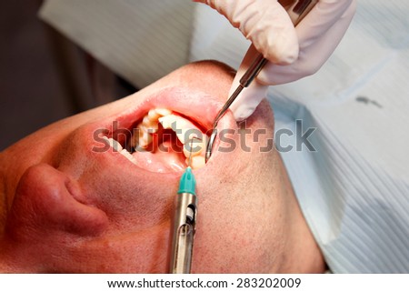 close up of an injection with a syringe in the gums under the teeth