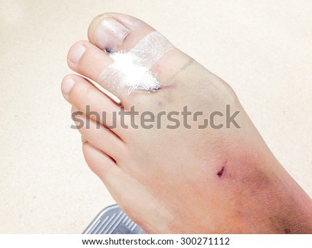 Close-up of disabled Patient's Leg before splint. broken thumb pedicures. broken foot. wound healing.