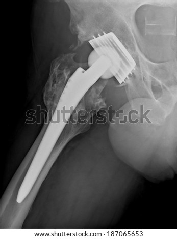 Xray imaging of permanent total hip arthroplasty