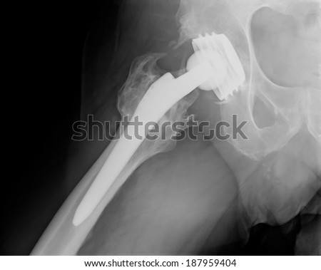 Xray imaging of permanent total hip arthroplasty