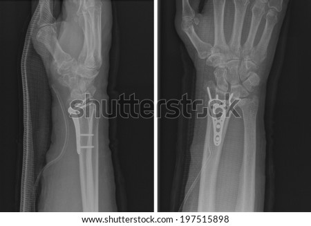 Xray imaging of epiphysial radial fracture of wrist reduced with permanent synthetic means