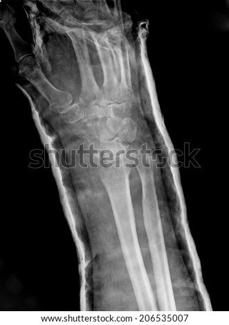 Xray imaging of epiphysial radial fracture of wrist reduced with permanent synthetic means