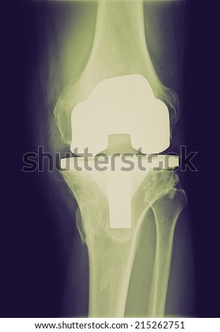 Vintage looking Xray imaging of bi compartmental knee prosthesis