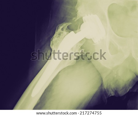 Vintage looking Xray imaging of permanent total hip arthroplasty