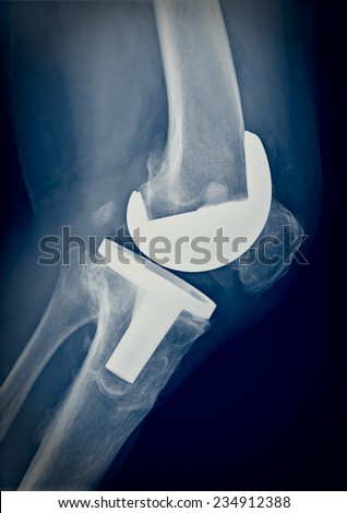 Xray imaging of bi compartmental knee prosthesis