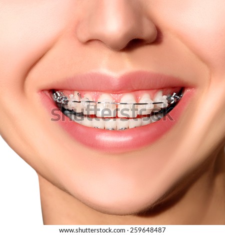 Braces on Teeth. Braces Smile. Orthodontic Treatment. Closeup Smiling Face with Braces.
